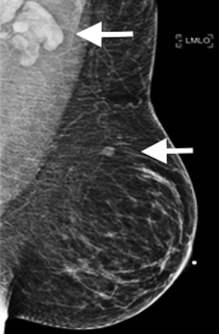 что такое маммография молочных желез фото